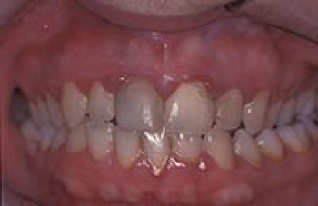 Gum disease treatment in Greenwich