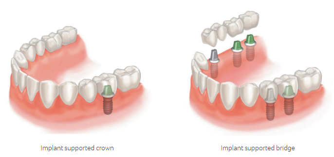 dental implant crown and bridge example