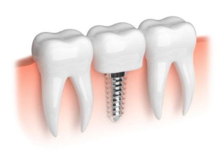 dental implant greenwich south east london