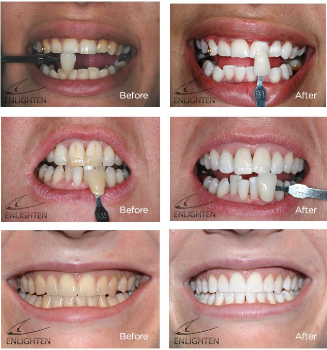 Enlighten teeth whitening in Greenwich London