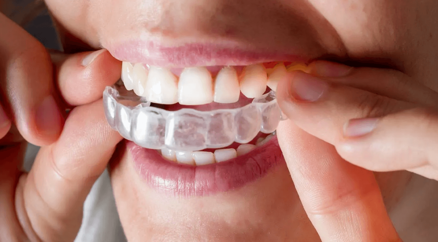 orthodontists greenwich london invisible brace treatment