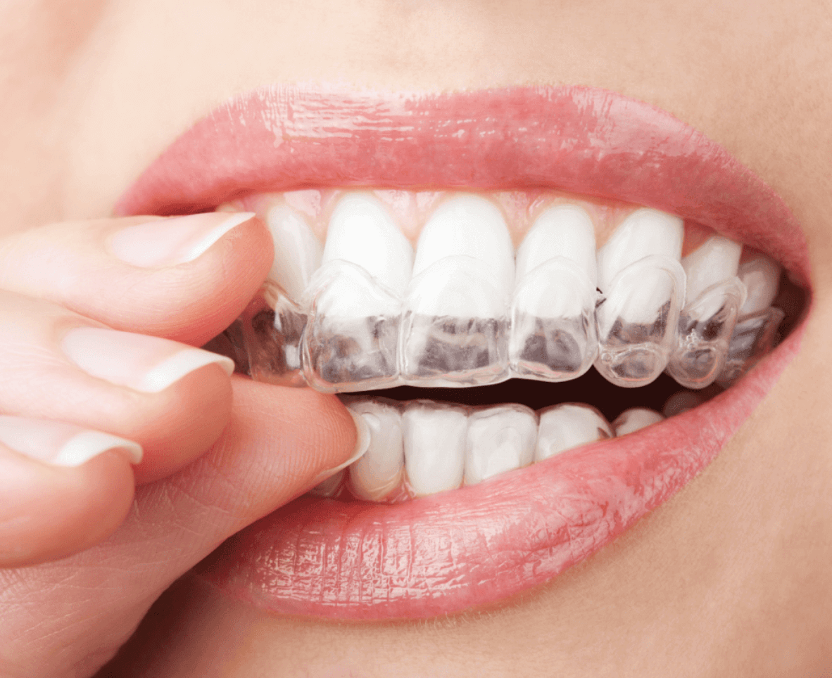 orthodontists greenwich london removable braces