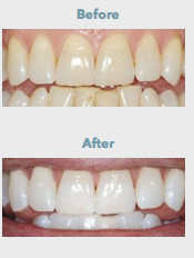 Polanight teeth whitening in Greenwich London