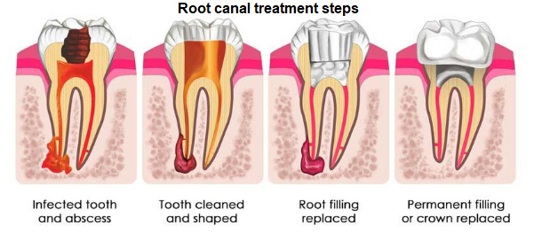 Root canal specialist London endodontic treatment explained